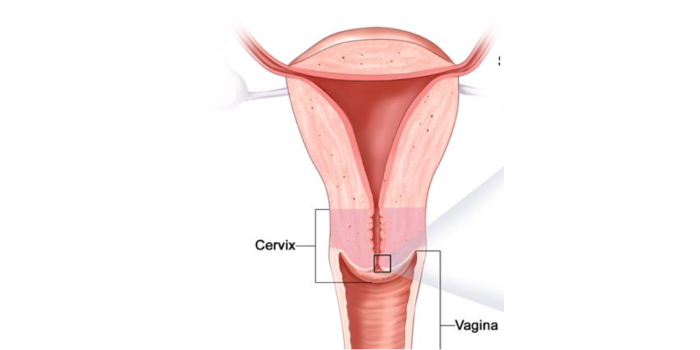 Cervical Cancer Treatment