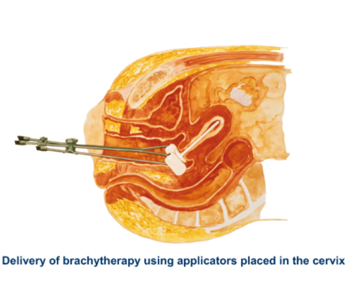 Internal Radiation Therapy | Cancer Treatment