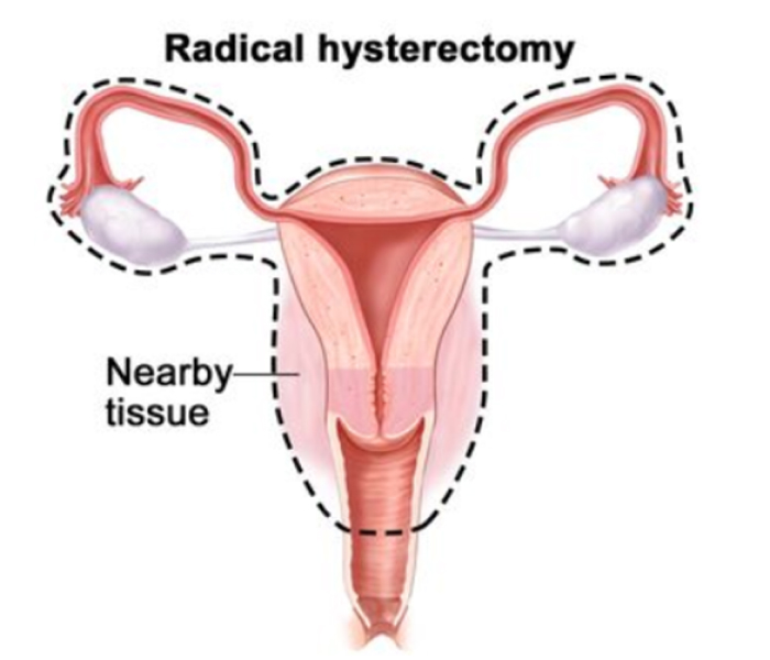 Radical Hysterectomy Treatment & Management