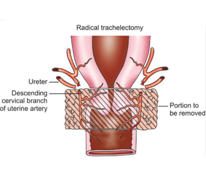 Radical Trachelectomy For Cervical Cancer