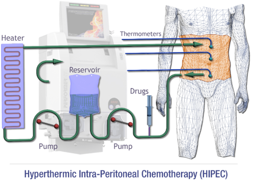 Hyperthermic Intraperitoneal Chemotherapy