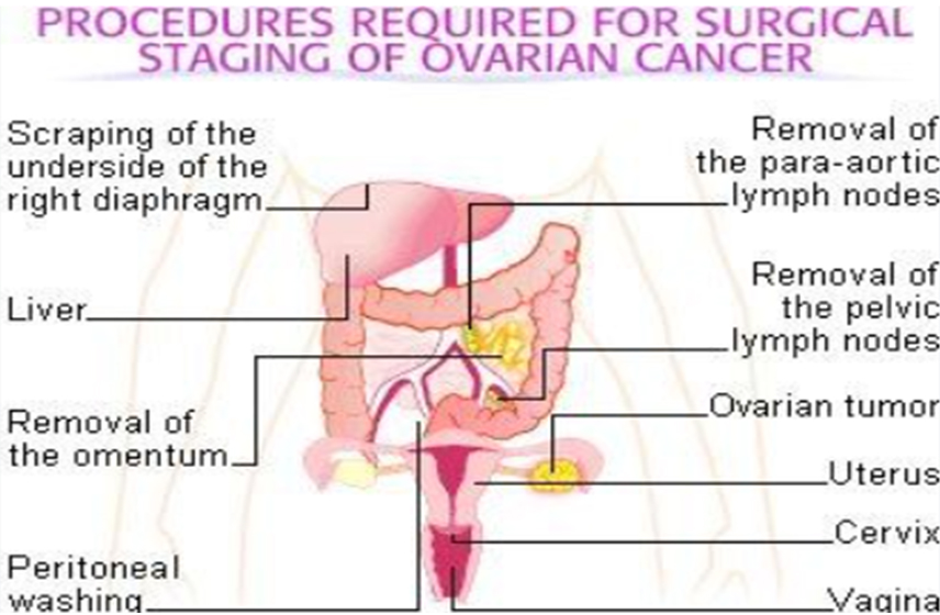 Surgery For Ovarian Cancer