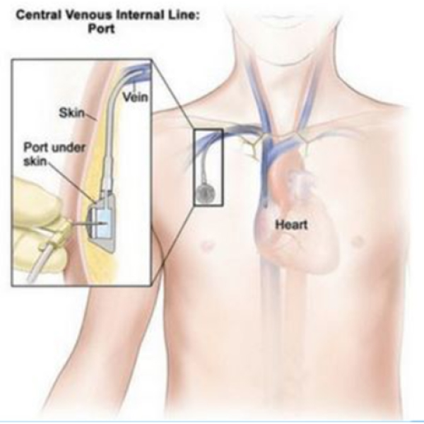 Chemoport Insertion Treatment