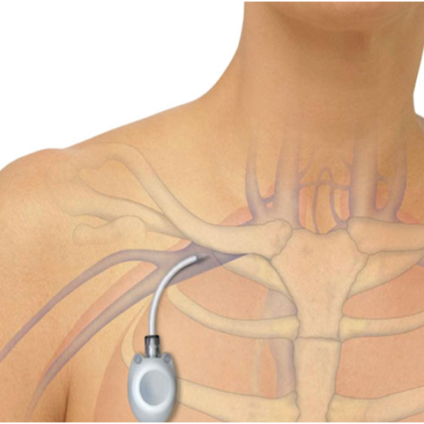 Chemoport Insertion