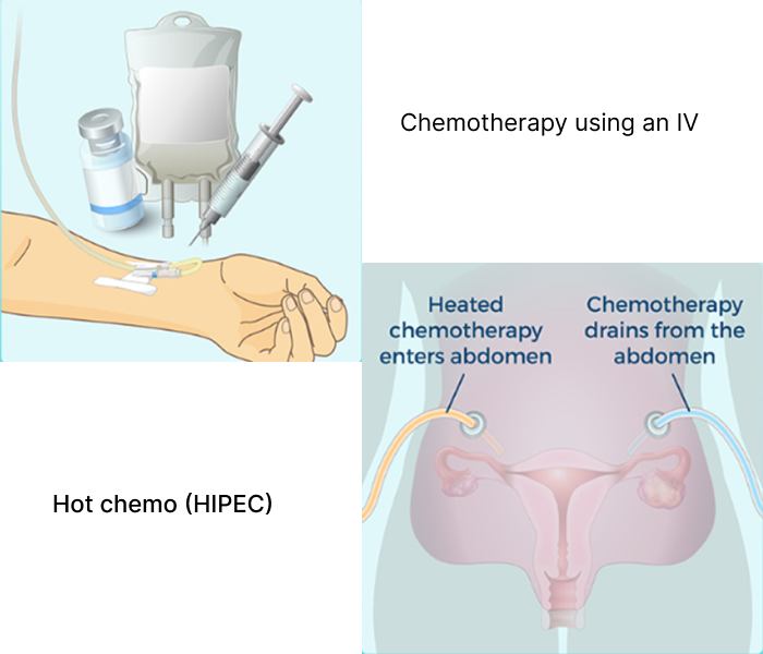 Chemotherapy Using Iv | Reproductive Cancer Experts