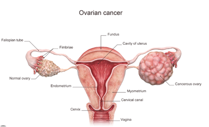 Ovarian Cancer Treatment