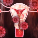 Uterus cancer treatment