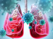 Lung cancer treatment