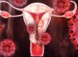 Uterus cancer treatment