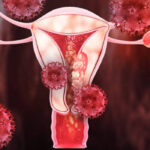 Uterus cancer treatment